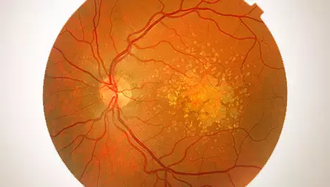 Dry-AMD visualisation