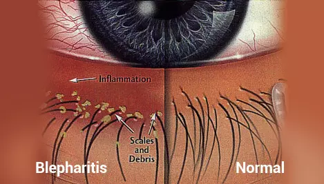 Blepharitis Visualization
