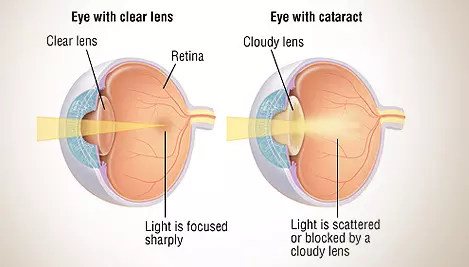 Cataract Visualization