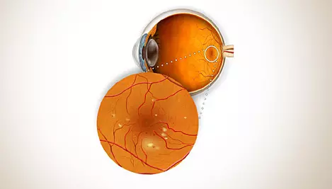 Diabetic retinopathy