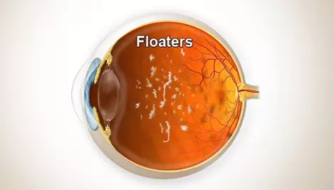 flashes & floaters