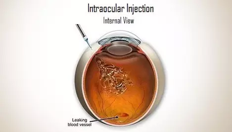 ANTI-VEGF Intra Vitreal Injections