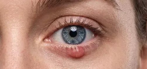 Meibomian Cyst