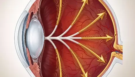 Ocular Hypertension