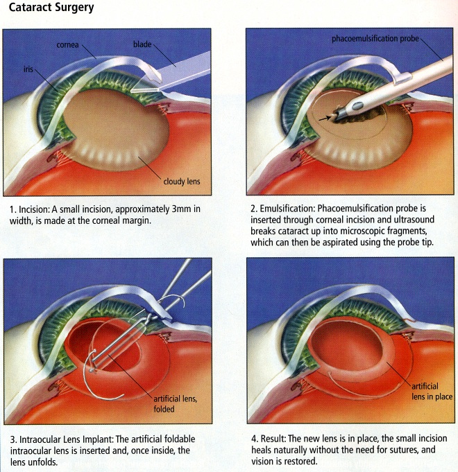 cataract surgery