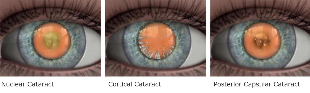 types of cataract